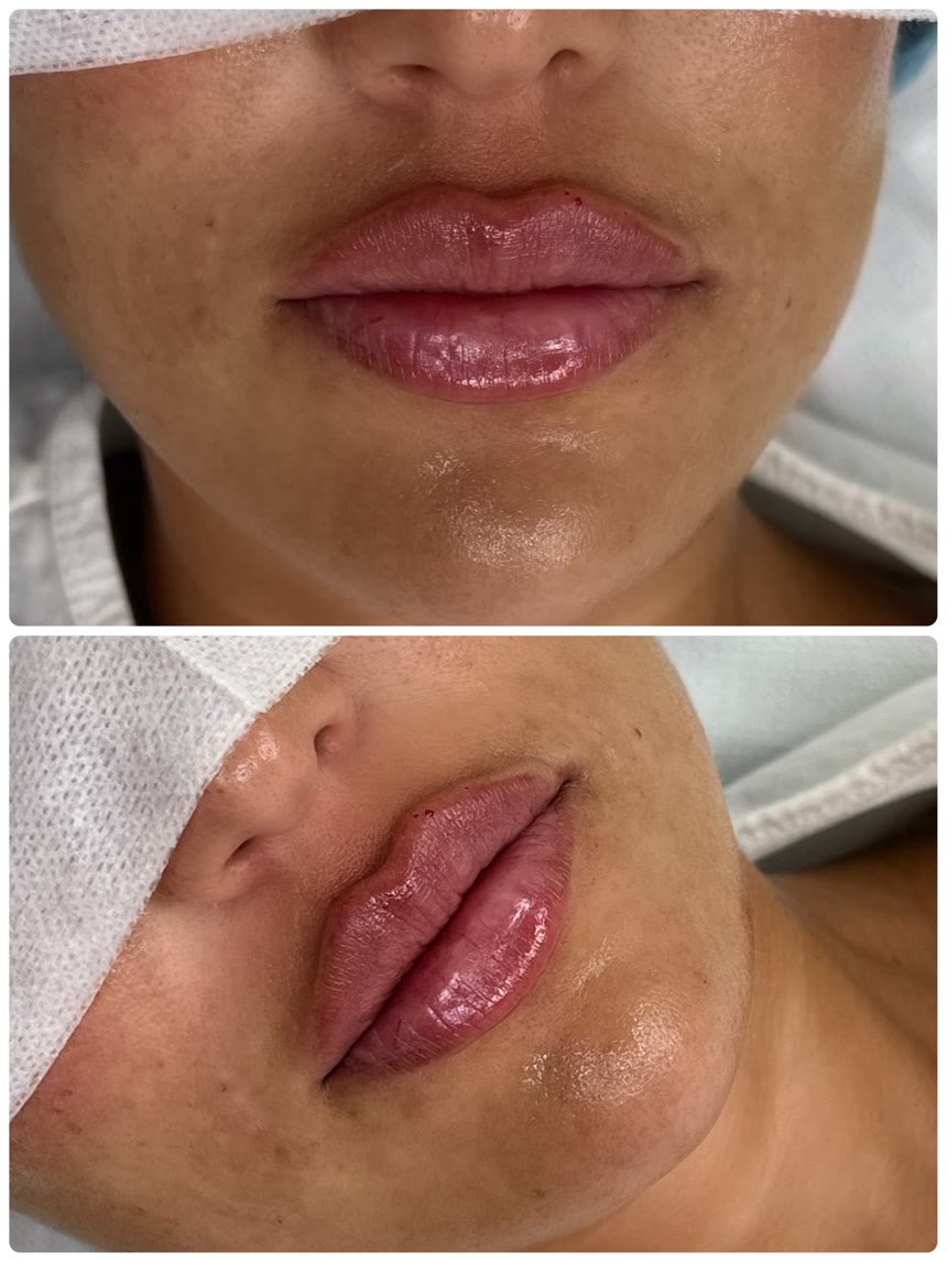 Lip filler before and after — Dr. Belove result