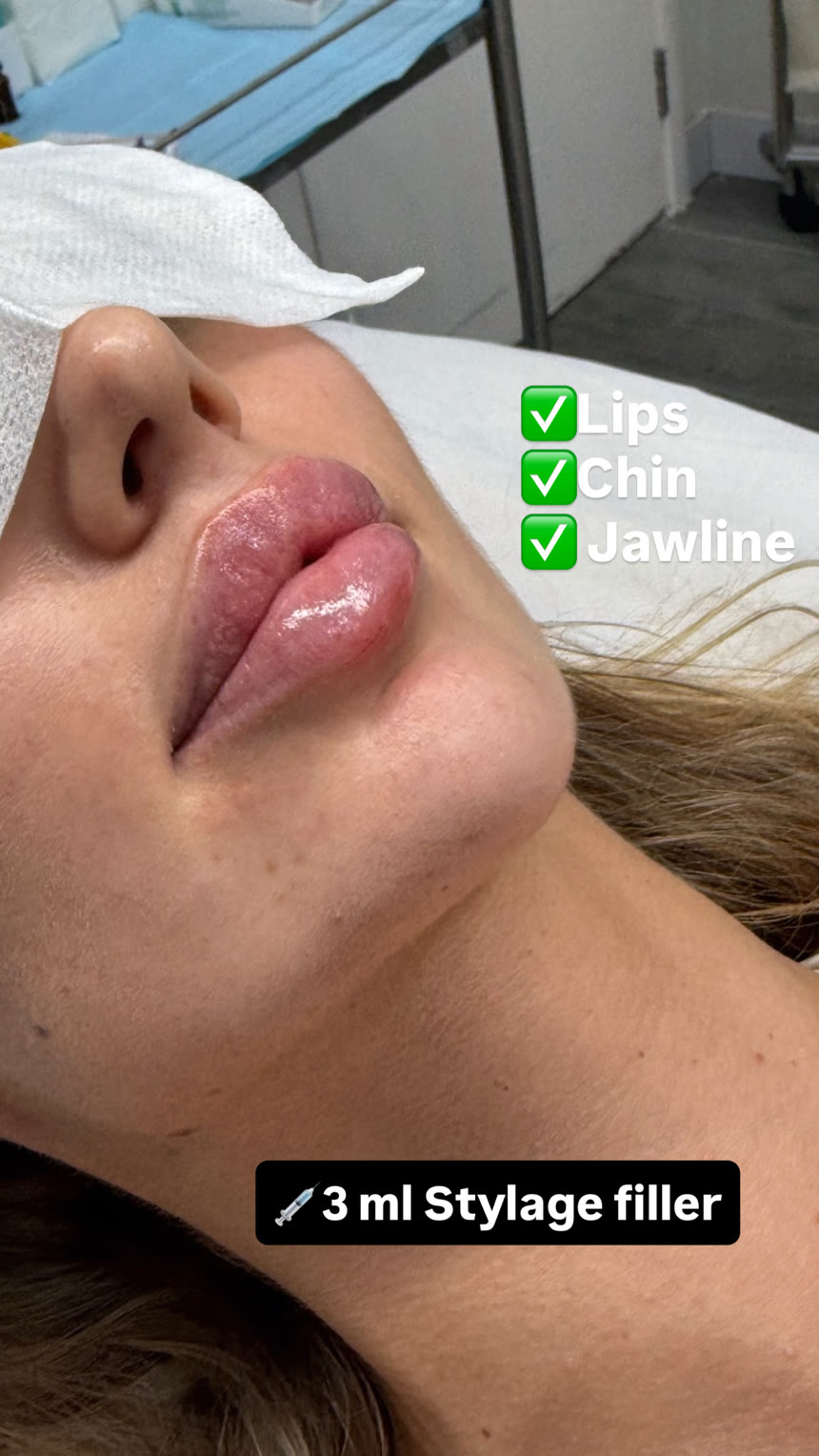 Lip filler before and after — Dr. Belove result
