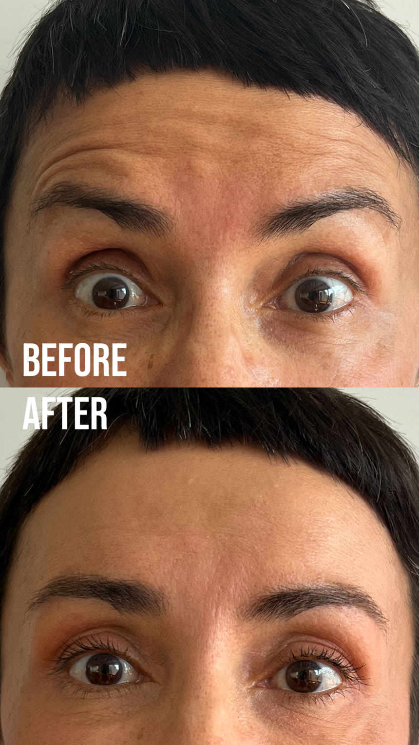 Botox before and after — Dr. Belove result