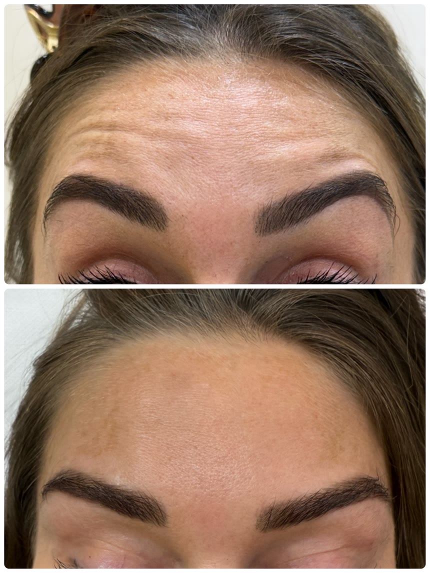 Botox before and after — Dr. Belove result