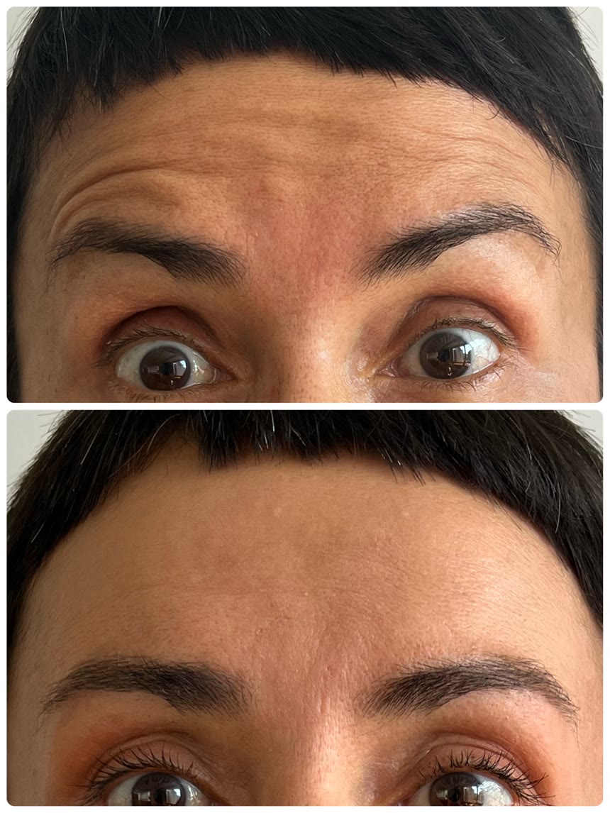 Botox before and after — Dr. Belove result
